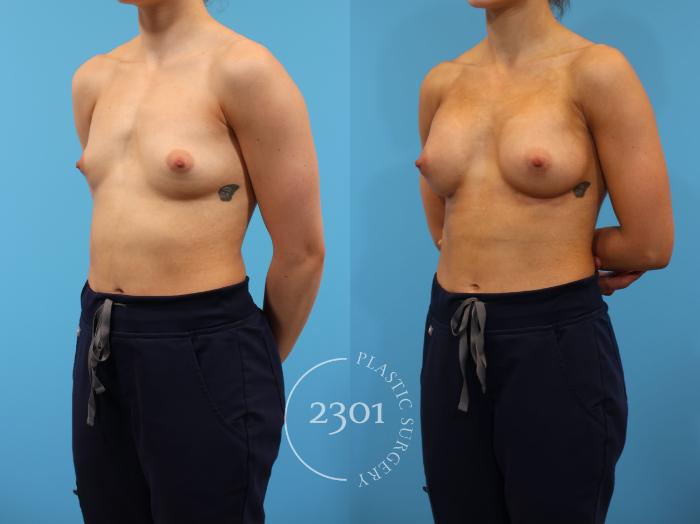 Before & After Breast Augmentation Case 915 Left Oblique View in Fort Worth, Plano, & Frisco, Texas
