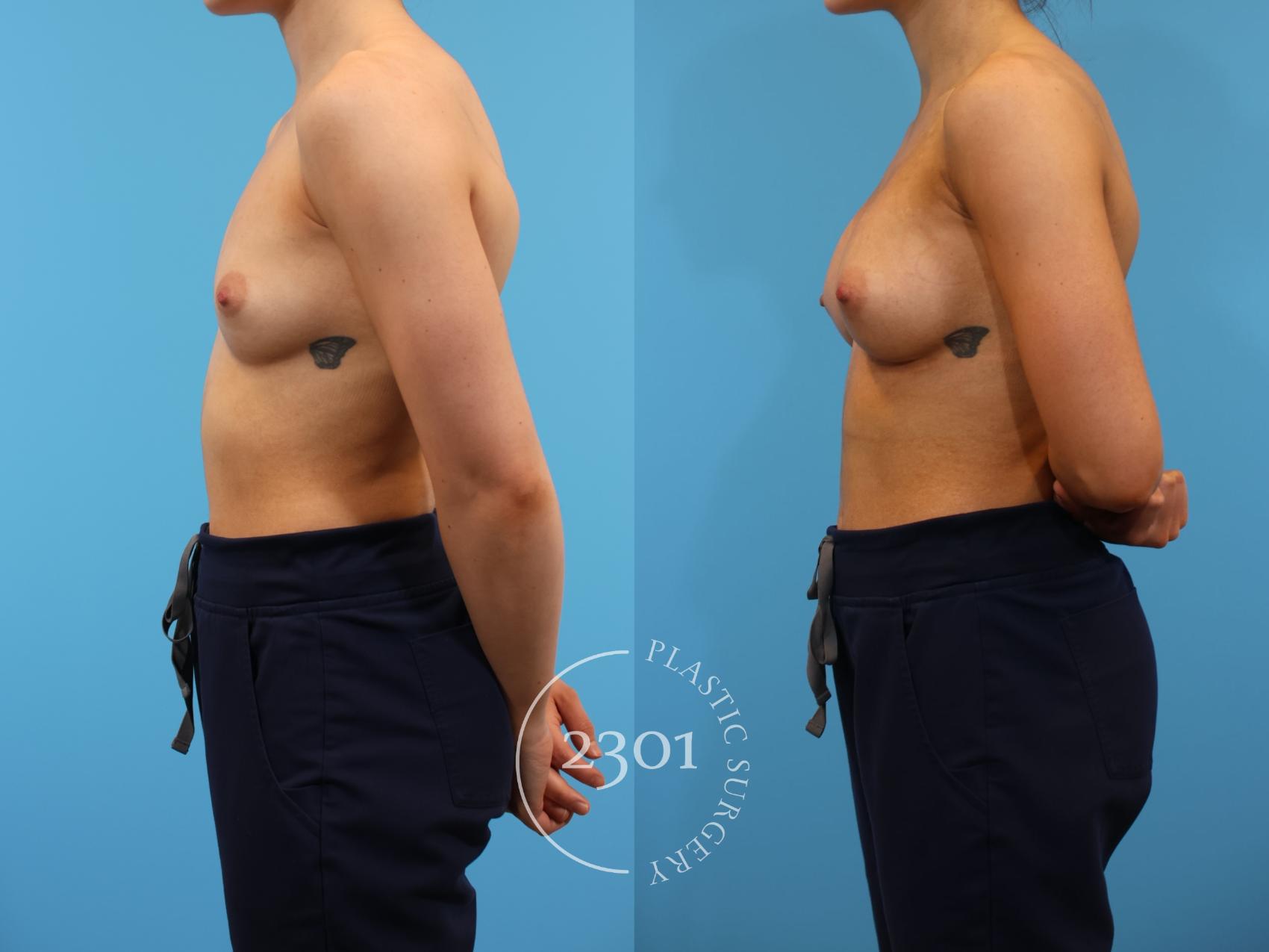 Before & After Breast Augmentation Case 915 Left Side View in Fort Worth, Plano, & Frisco, Texas