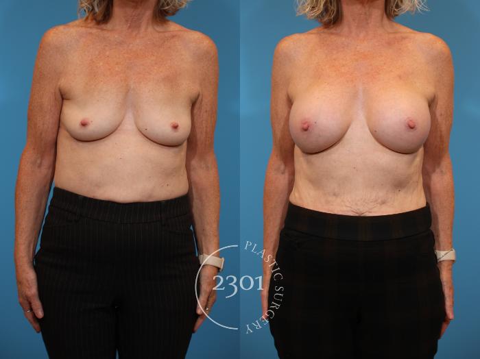 Before & After Breast Augmentation Case 938 Front View in Fort Worth, Plano, & Frisco, Texas