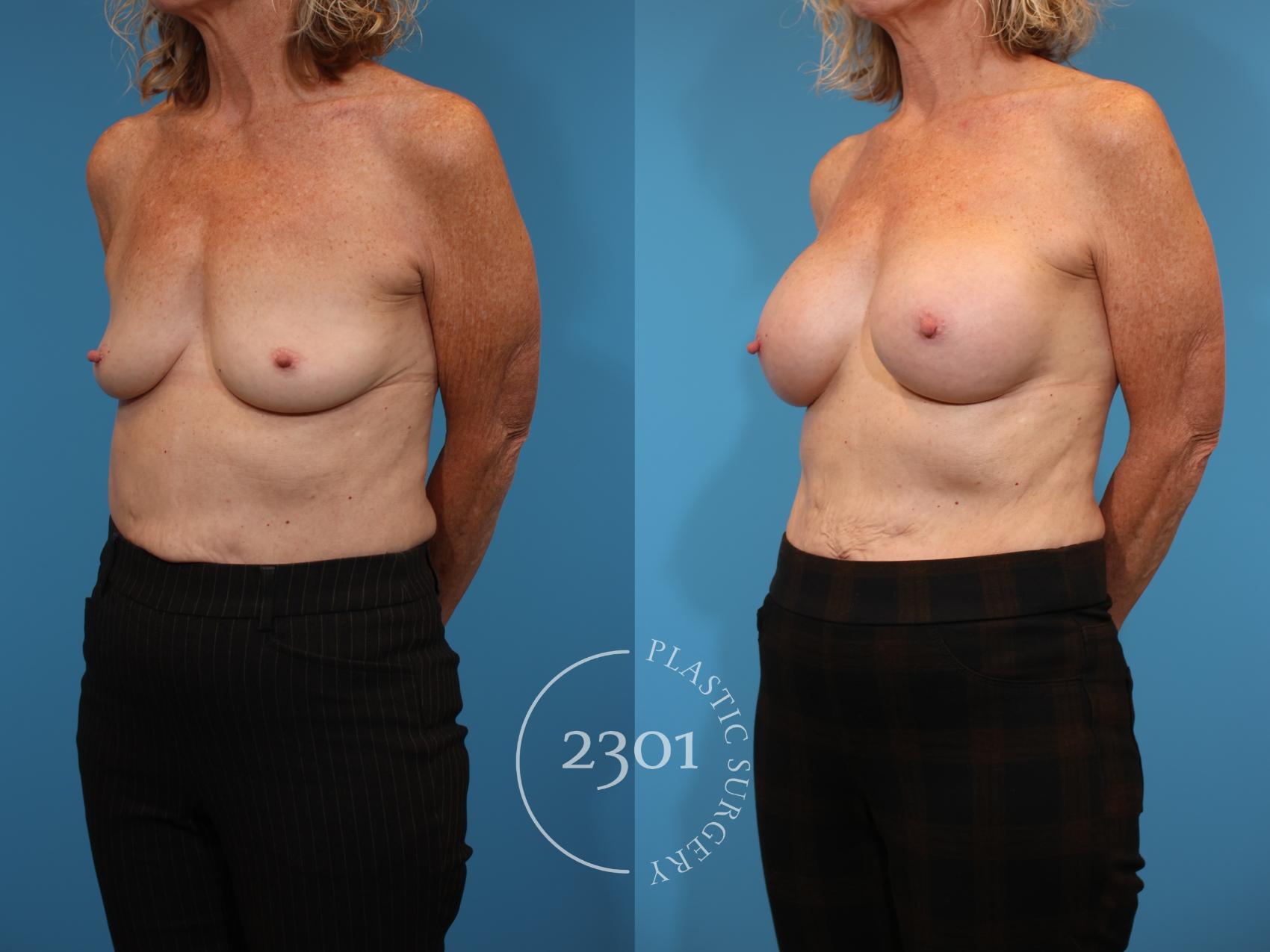 Before & After Breast Augmentation Case 938 Left Oblique View in Fort Worth, Plano, & Frisco, Texas