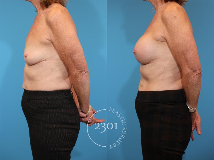 Before & After Breast Augmentation Case 938 Left Side View in Fort Worth, Plano, & Frisco, Texas