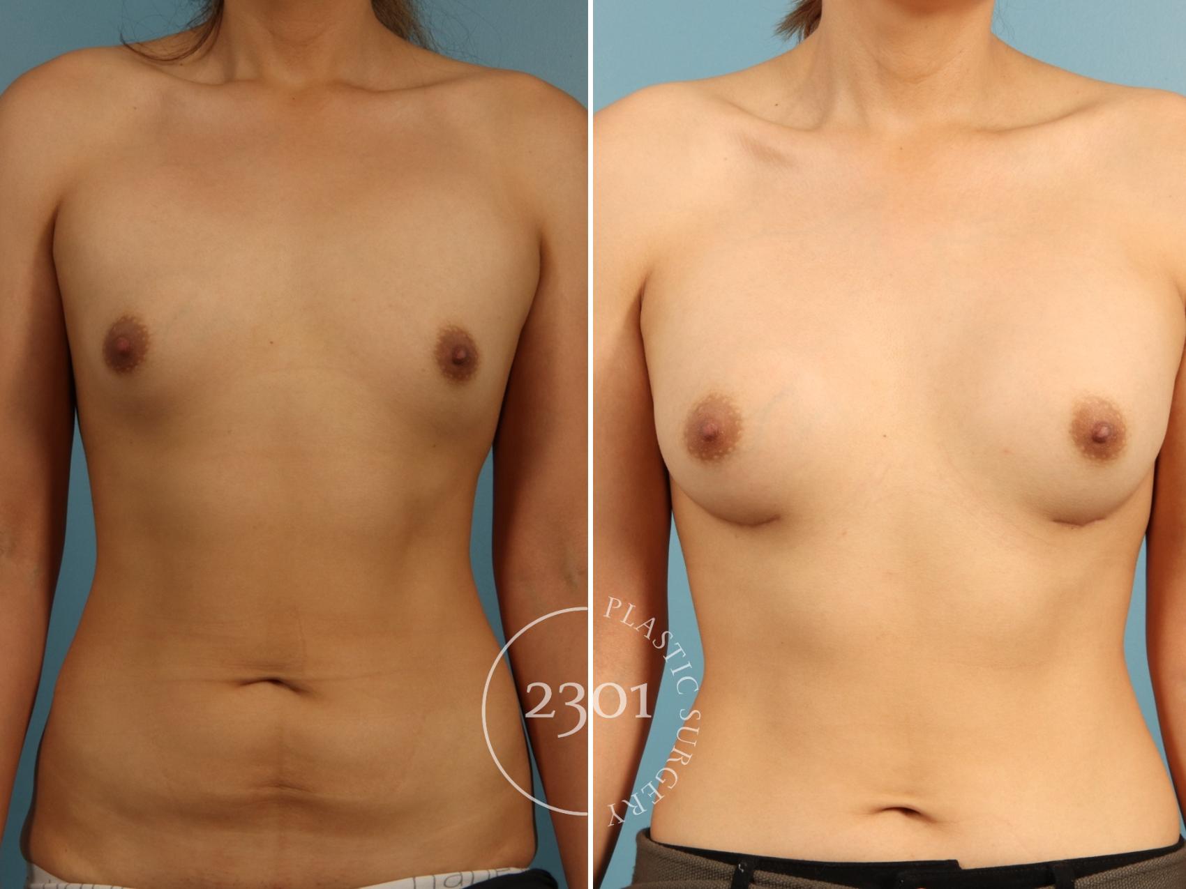 Before & After Breast Augmentation Case 952 Front View in Fort Worth, Plano, & Frisco, Texas