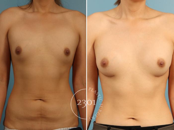 Before & After Breast Augmentation Case 952 Front View in Fort Worth, Plano, & Frisco, Texas