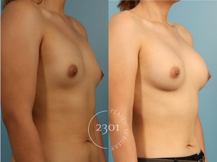 Before & After Breast Augmentation Case 952 Left Oblique View in Fort Worth, Plano, & Frisco, Texas