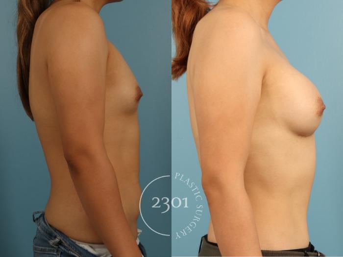 Before & After Breast Augmentation Case 952 Left Side View in Fort Worth, Plano, & Frisco, Texas