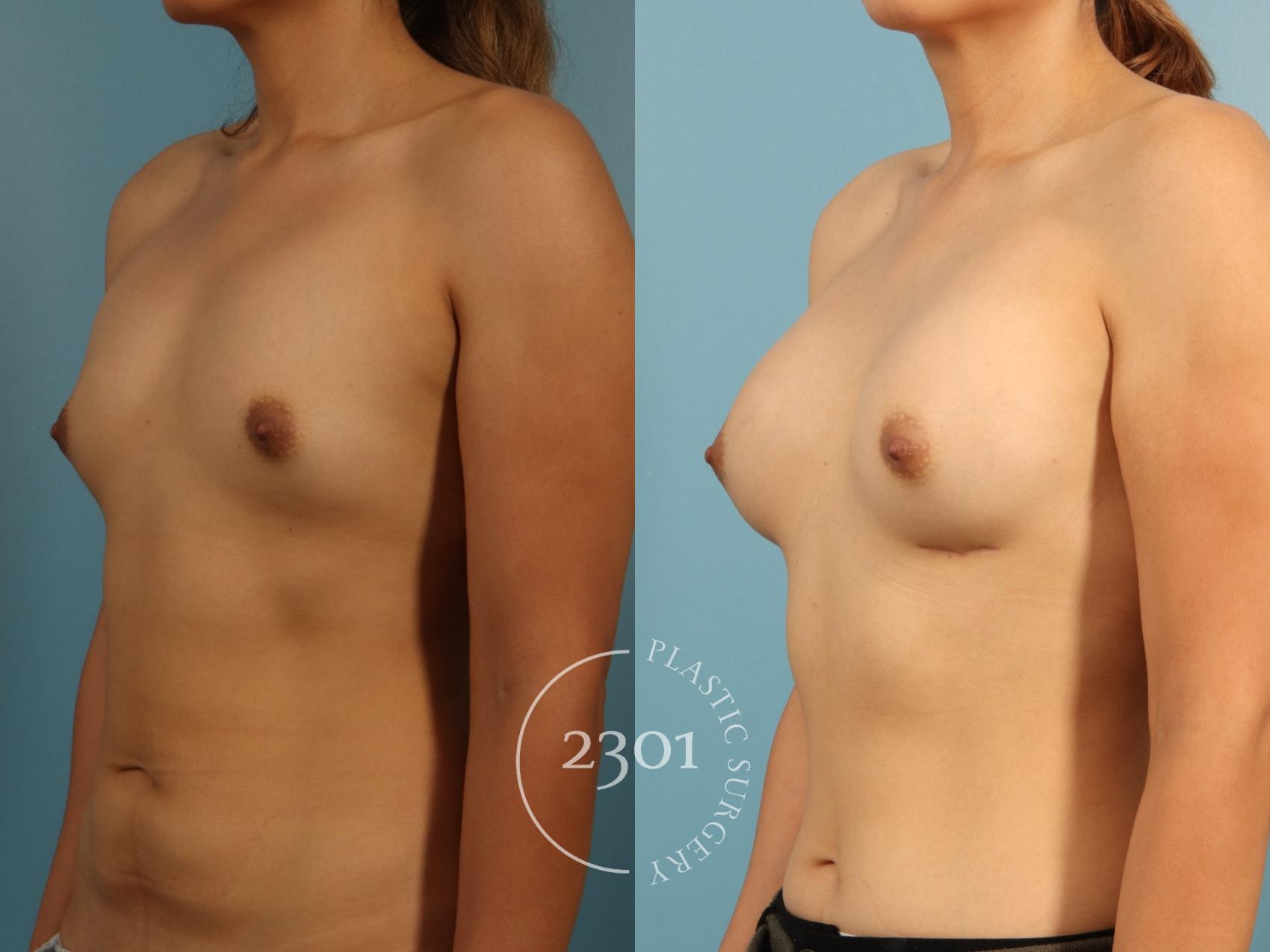 Before & After Breast Augmentation Case 952 Right Oblique View in Fort Worth, Plano, & Frisco, Texas
