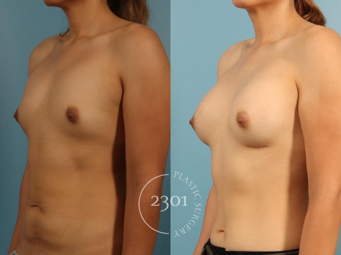 Before & After Breast Augmentation Case 952 Right Oblique View in Fort Worth, Plano, & Frisco, Texas