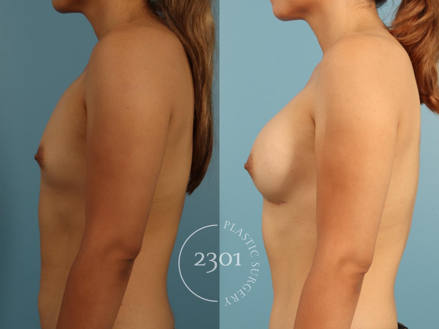 Before & After Breast Augmentation Case 952 Right Side View in Fort Worth, Plano, & Frisco, Texas