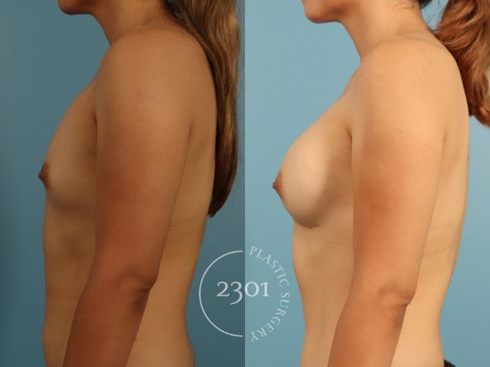 Before & After Breast Augmentation Case 952 Right Side View in Fort Worth, Plano, & Frisco, Texas