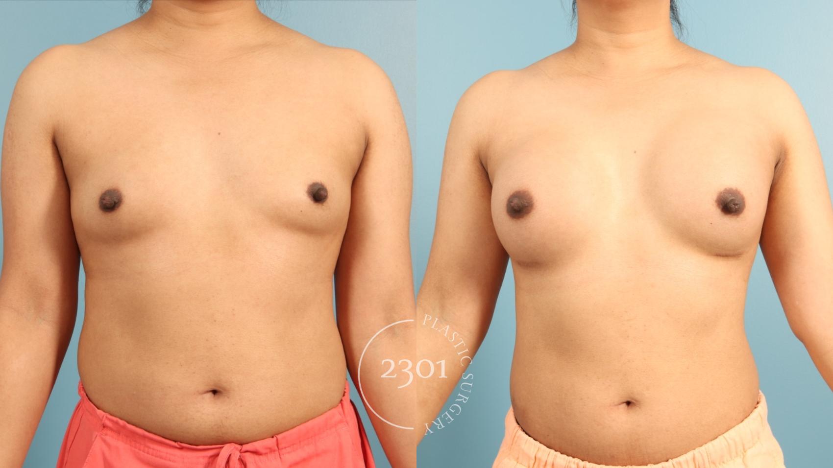 Before & After Breast Augmentation Case 953 Front View in Fort Worth, Plano, & Frisco, Texas