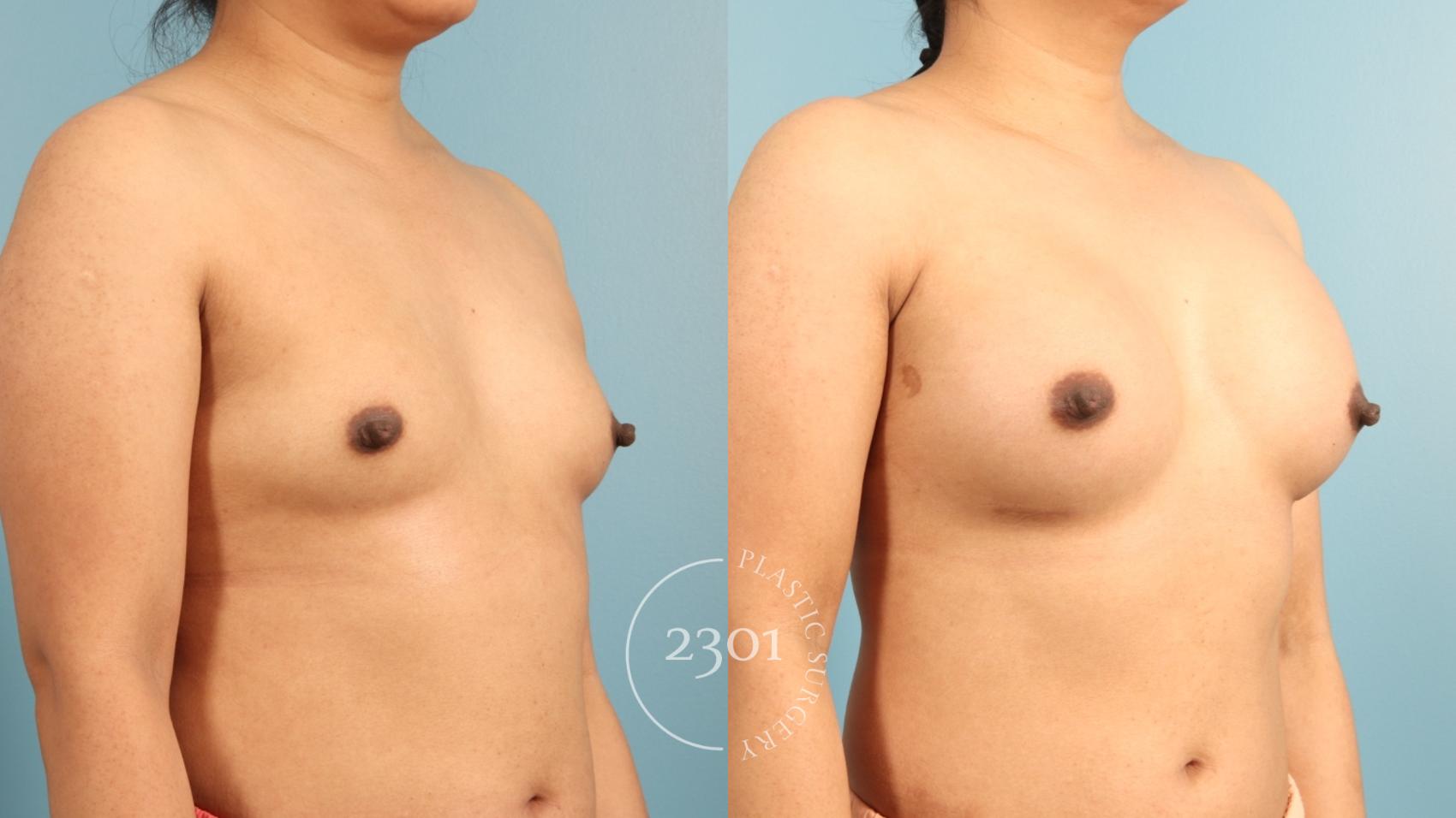 Before & After Breast Augmentation Case 953 Left Oblique View in Fort Worth, Plano, & Frisco, Texas