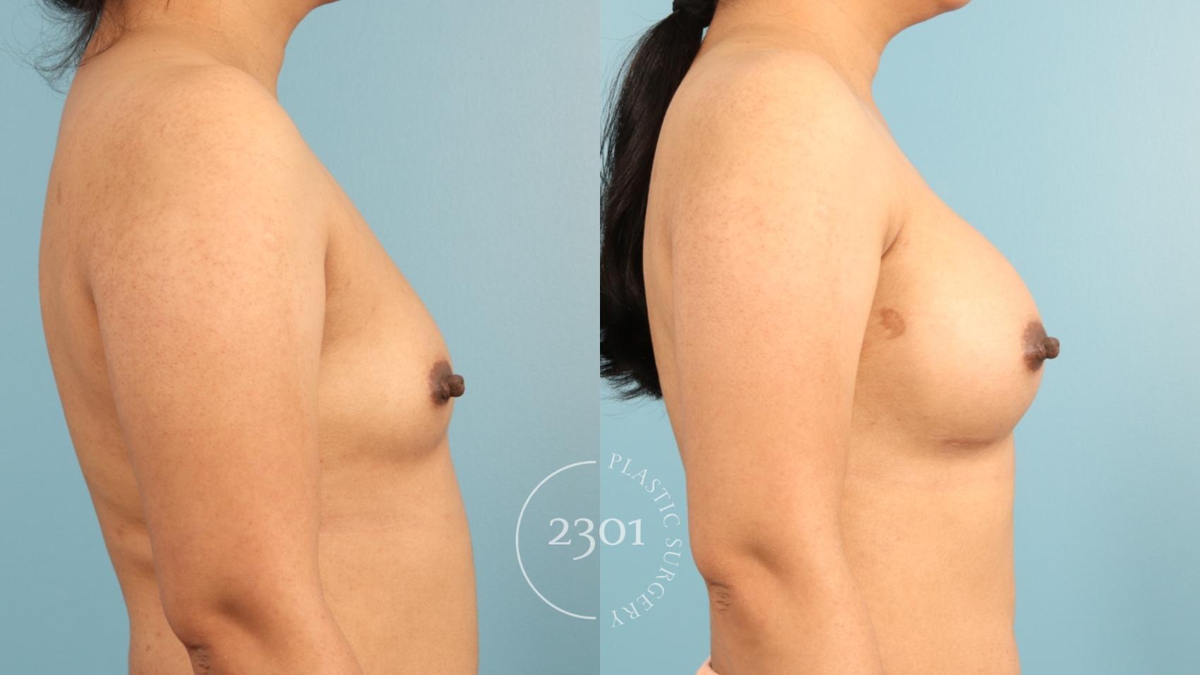 Before & After Breast Augmentation Case 953 Left Side View in Fort Worth, Plano, & Frisco, Texas