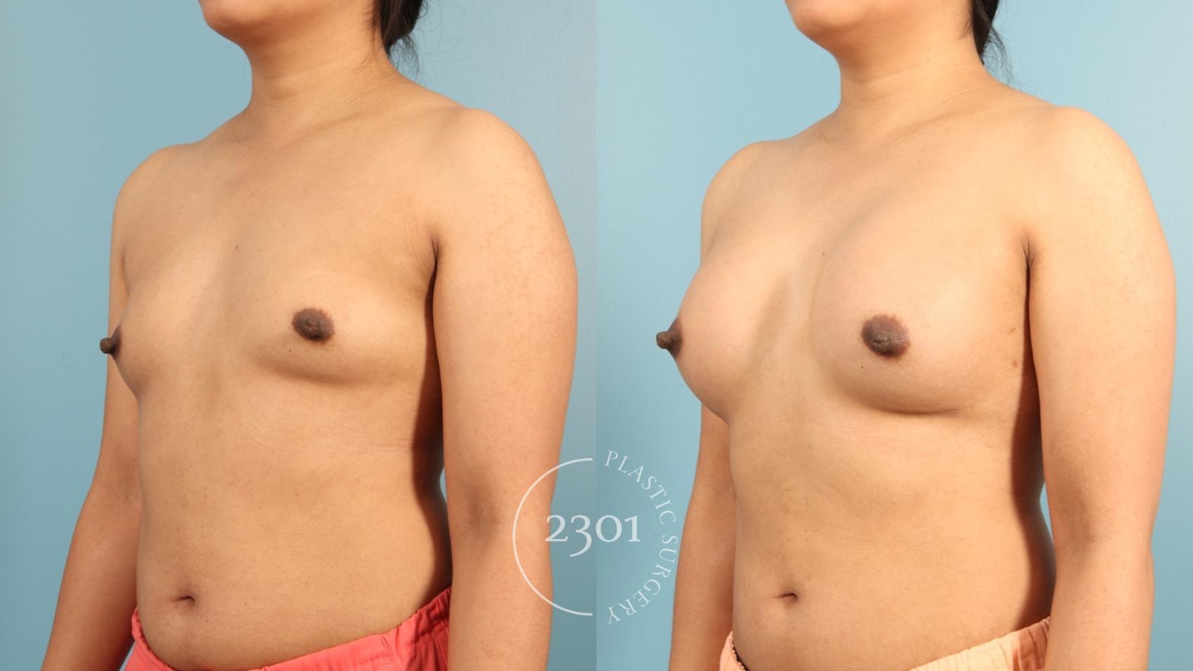 Before & After Breast Augmentation Case 953 Right Oblique View in Fort Worth, Plano, & Frisco, Texas