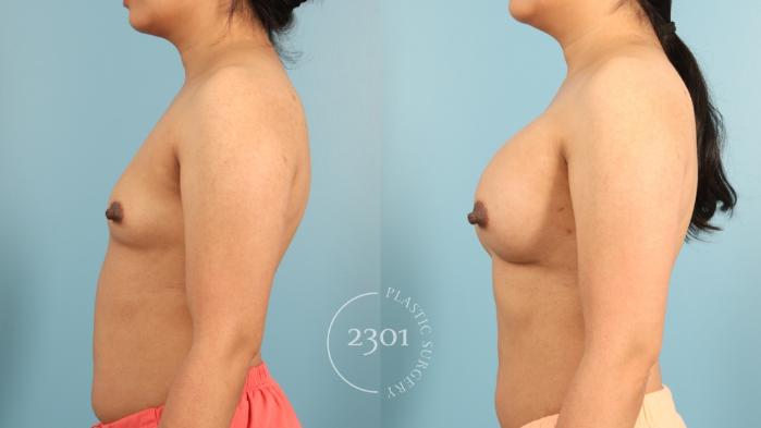 Before & After Breast Augmentation Case 953 Right Side View in Fort Worth, Plano, & Frisco, Texas