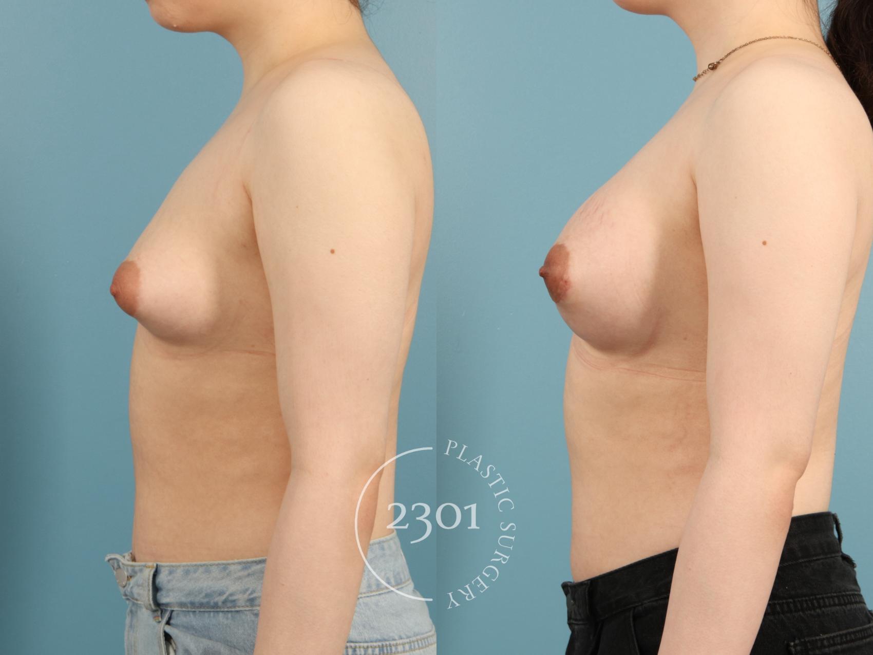 Before & After Breast Augmentation Case 954 Left Oblique View in Fort Worth, Plano, & Frisco, Texas