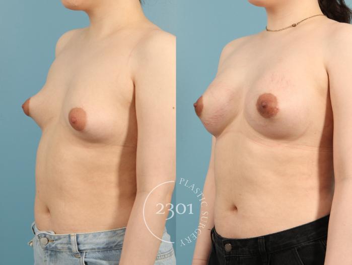 Before & After Breast Augmentation Case 954 Left Side View in Fort Worth, Plano, & Frisco, Texas
