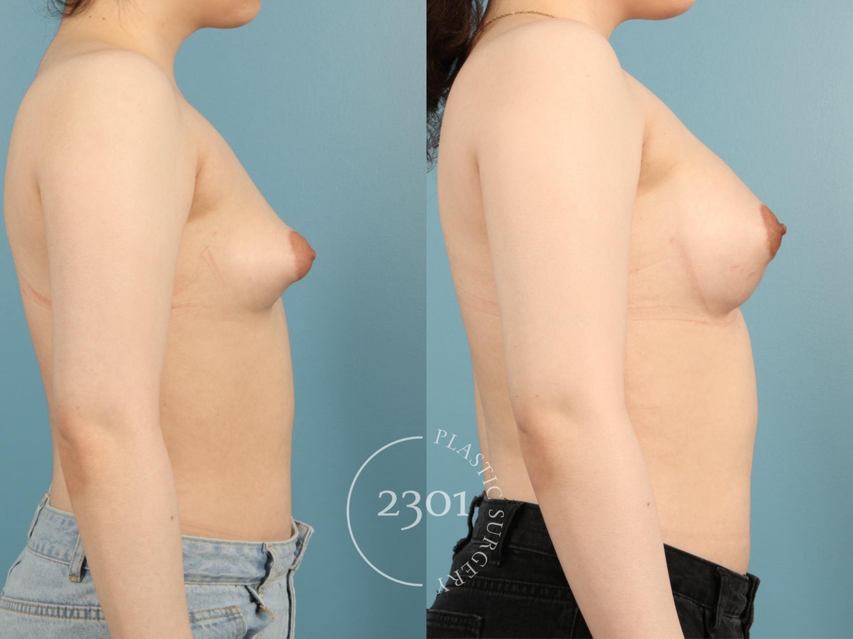 Before & After Breast Augmentation Case 954 Right Side View in Fort Worth, Plano, & Frisco, Texas
