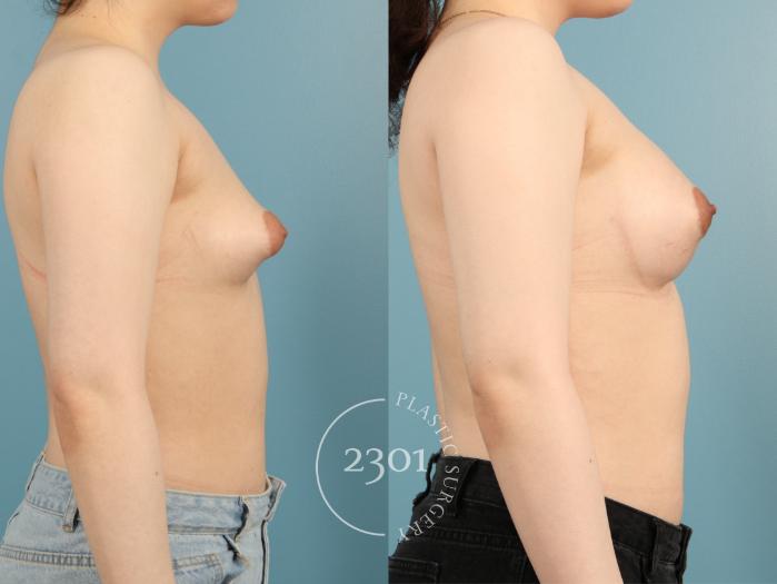 Before & After Breast Augmentation Case 954 Right Side View in Fort Worth, Plano, & Frisco, Texas