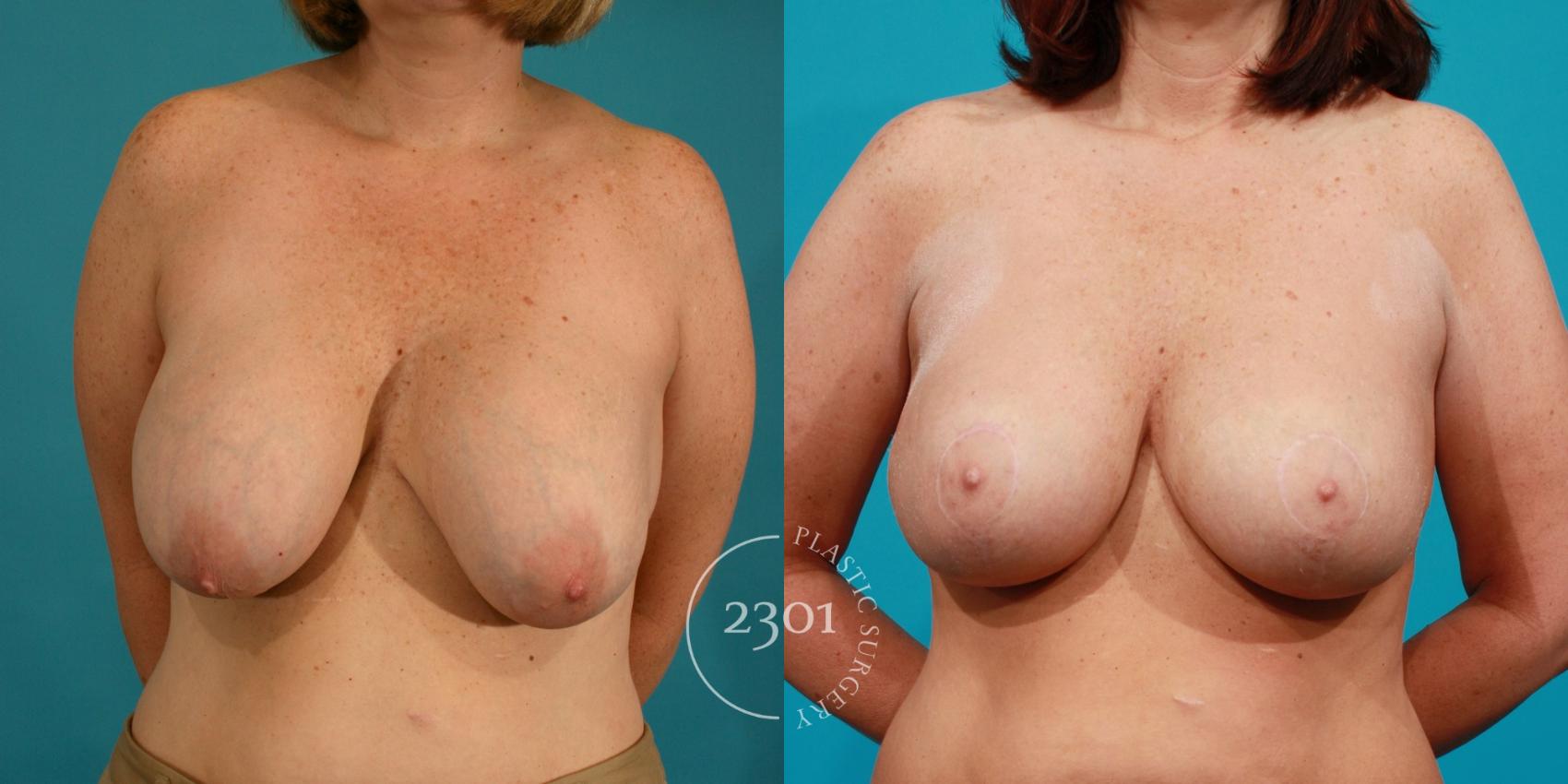 Before & After Silicone Implants Case 113 View #1 View in Fort Worth, Plano, & Frisco, Texas