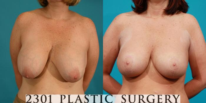 Before & After Breast Augmentation Revision Case 113 View #1 View in Fort Worth, Plano, & Frisco, Texas