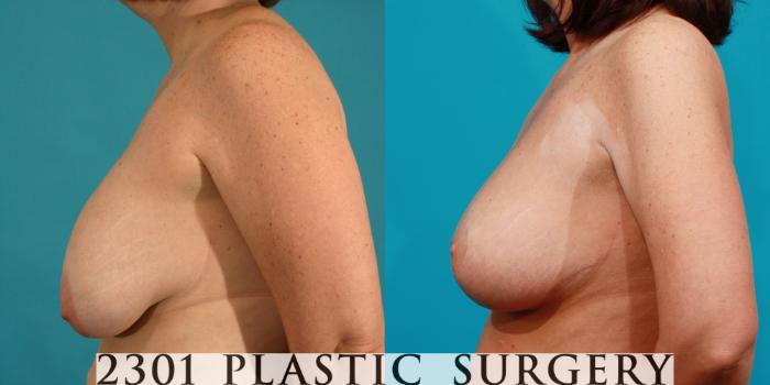 Before & After Breast Augmentation Revision Case 113 View #2 View in Fort Worth, Plano, & Frisco, Texas