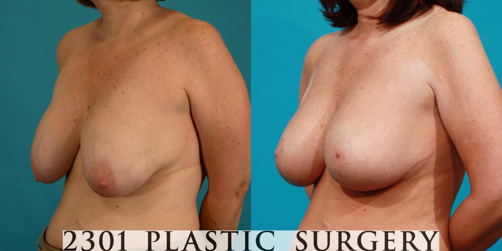 Before & After Breast Augmentation Revision Case 113 View #3 View in Fort Worth & Frisco, Texas
