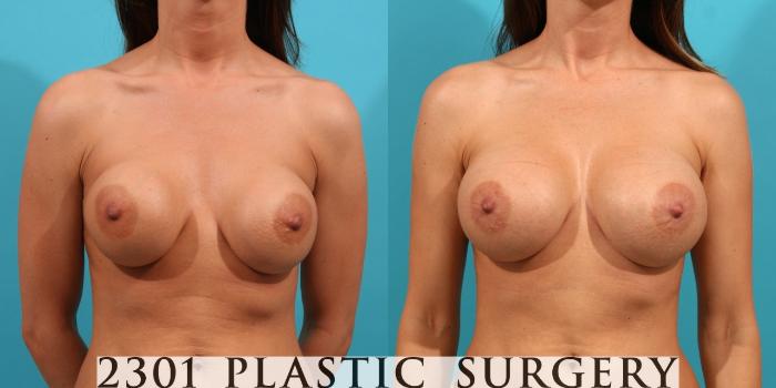 Before & After Silicone Implants Case 21 View #1 View in Fort Worth, Plano, & Frisco, Texas
