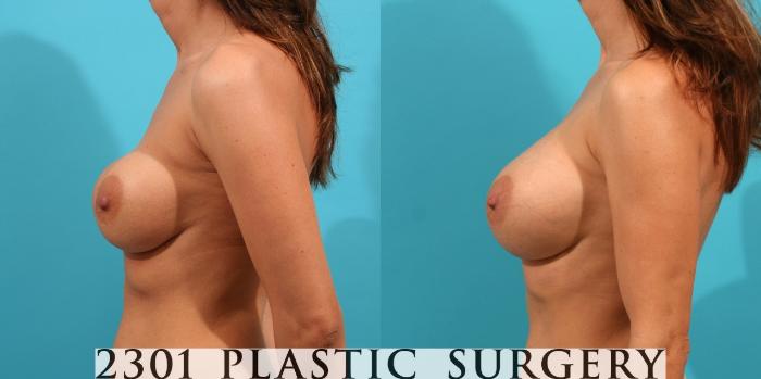 Before & After Silicone Implants Case 21 View #2 View in Fort Worth, Plano, & Frisco, Texas