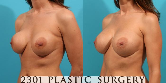 Before & After Silicone Implants Case 21 View #3 View in Fort Worth, Plano, & Frisco, Texas