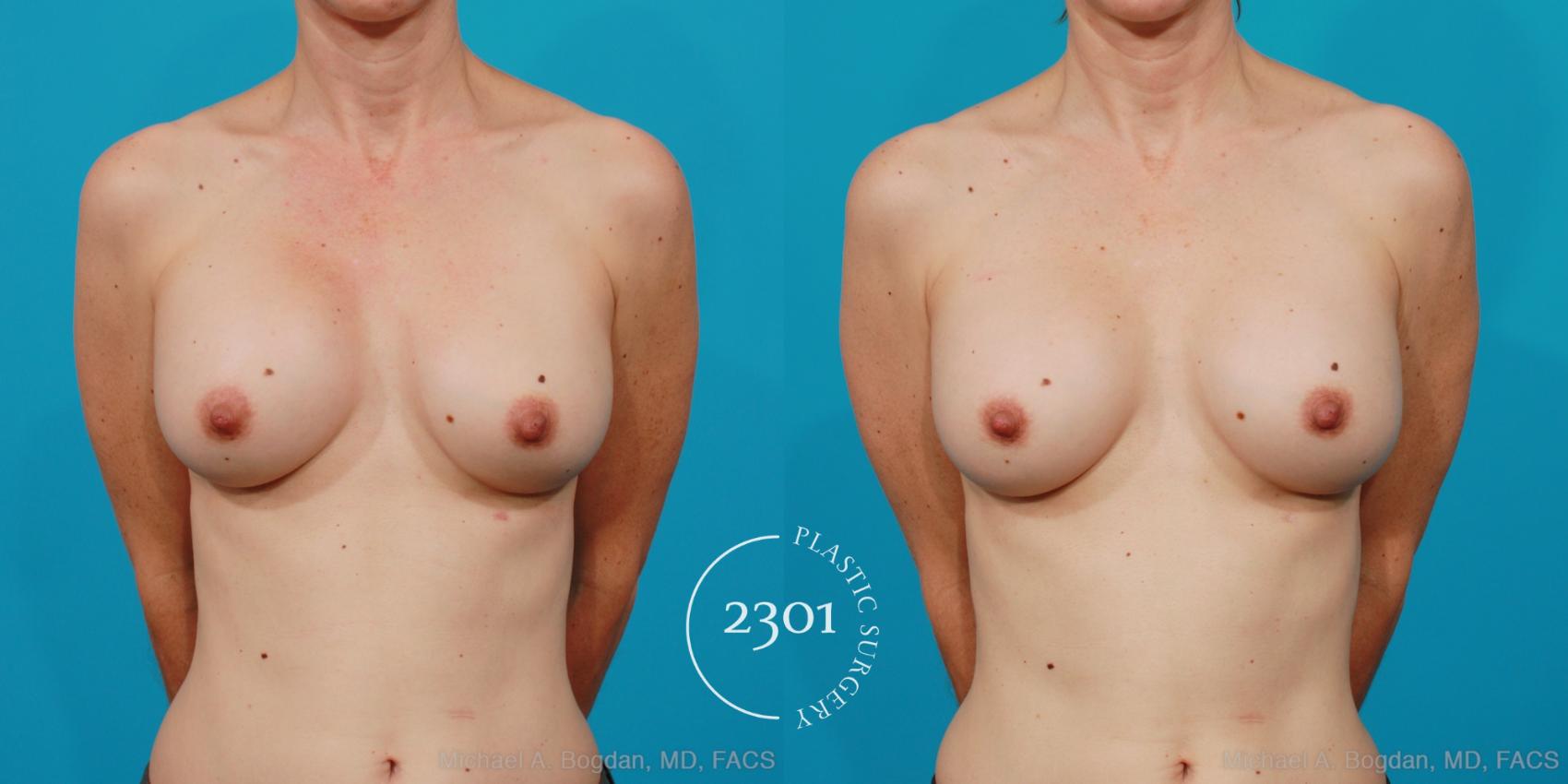 Before & After Breast Augmentation Revision Case 211 View #1 View in Fort Worth, Plano, & Frisco, Texas