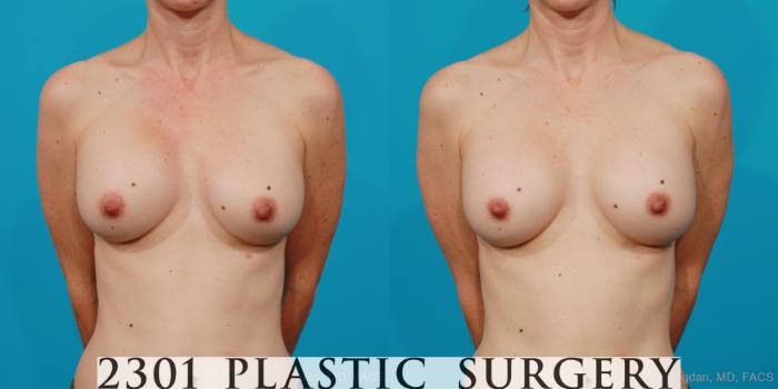 Before & After Breast Augmentation Revision Case 211 View #1 View in Fort Worth, Plano, & Frisco, Texas