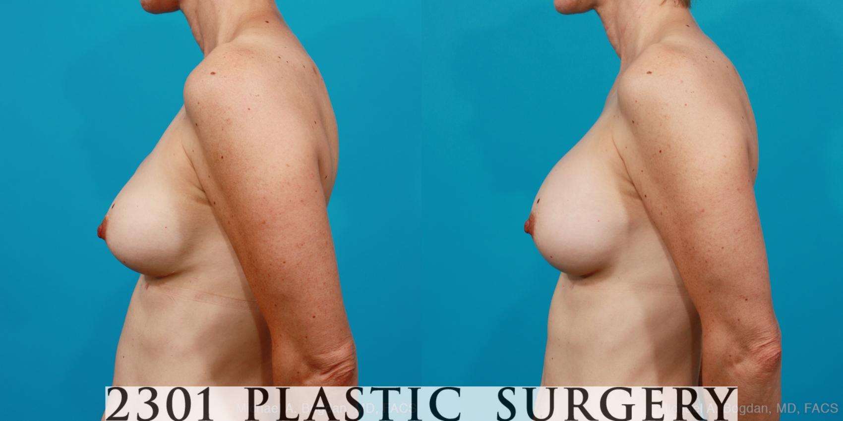 Before & After Breast Augmentation Revision Case 211 View #2 View in Fort Worth & Frisco, Texas