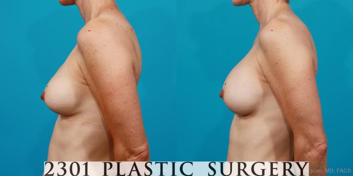 Before & After Breast Augmentation Revision Case 211 View #2 View in Fort Worth, Plano, & Frisco, Texas