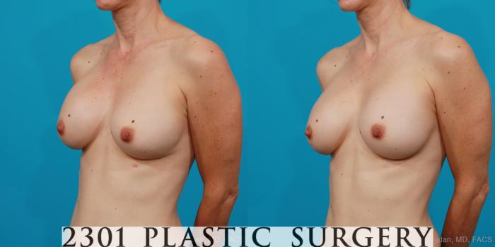 Before & After Breast Augmentation Revision Case 211 View #3 View in Fort Worth, Plano, & Frisco, Texas