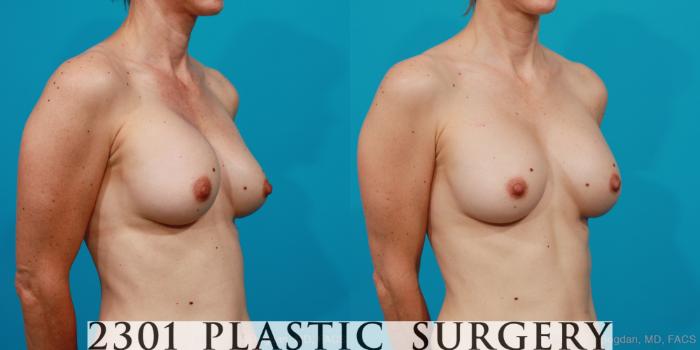 Before & After Breast Augmentation Revision Case 211 View #4 View in Fort Worth, Plano, & Frisco, Texas
