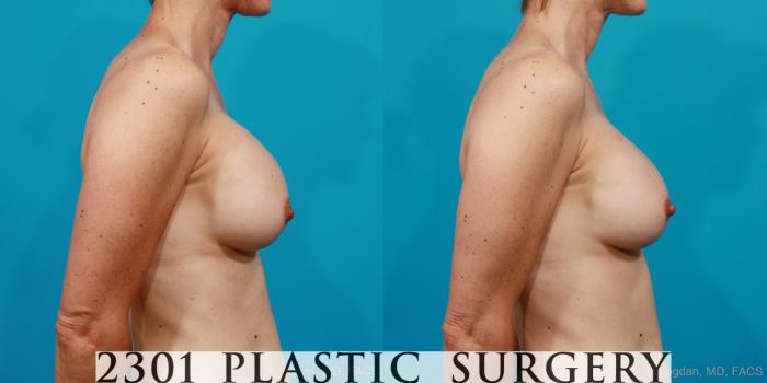 Before & After Saline Implants Case 211 View #5 View in Fort Worth, Plano, & Frisco, Texas