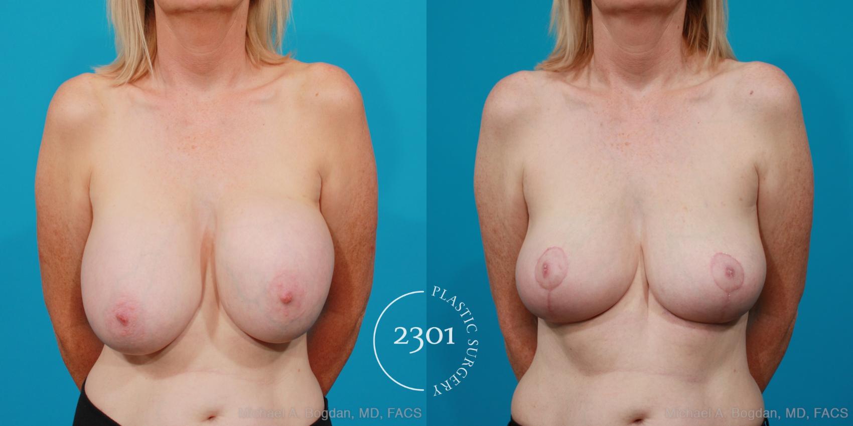 Before & After Breast Lift (Mastopexy) Case 216 View #1 View in Fort Worth, Plano, & Frisco, Texas