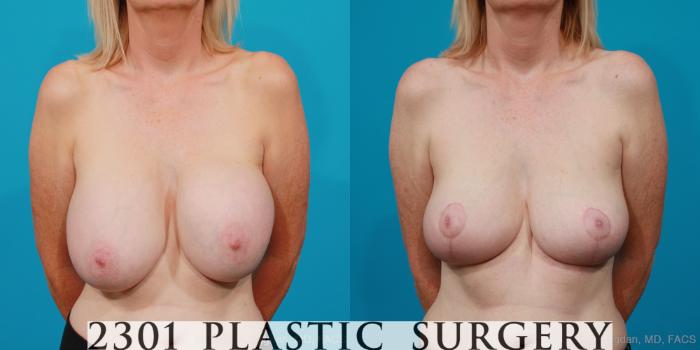 Before & After Breast Lift (Mastopexy) Case 216 View #1 View in Fort Worth, Plano, & Frisco, Texas