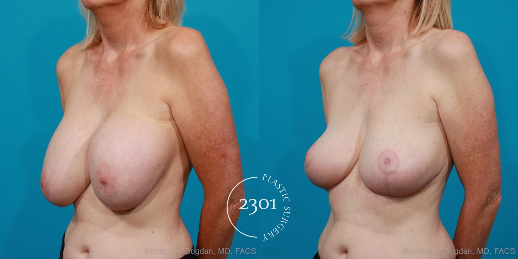 Before & After Breast Augmentation Revision Case 216 View #3 View in Fort Worth, Plano, & Frisco, Texas
