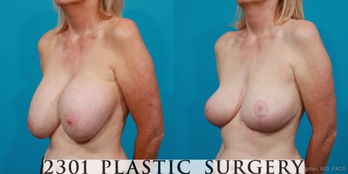 Before & After Breast Augmentation Revision Case 216 View #3 View in Fort Worth, Plano, & Frisco, Texas