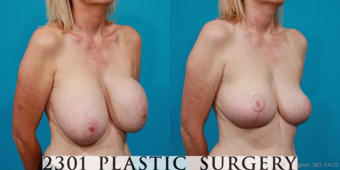 Before & After Breast Lift (Mastopexy) Case 216 View #4 View in Fort Worth, Plano, & Frisco, Texas