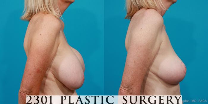 Before & After Breast Augmentation Revision Case 216 View #5 View in Fort Worth, Plano, & Frisco, Texas