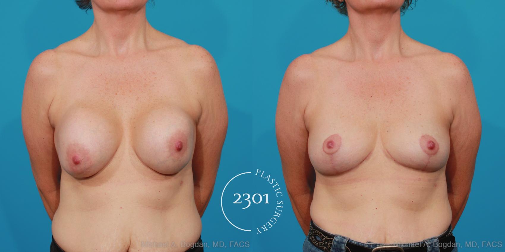 Before & After Breast Augmentation Revision Case 234 View #1 View in Fort Worth, Plano, & Frisco, Texas