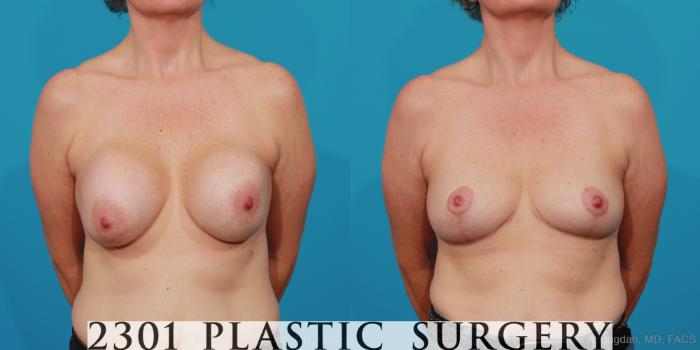Before & After Breast Augmentation Revision Case 234 View #1 View in Fort Worth, Plano, & Frisco, Texas