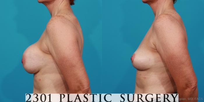Before & After Breast Lift (Mastopexy) Case 234 View #2 View in Fort Worth, Plano, & Frisco, Texas