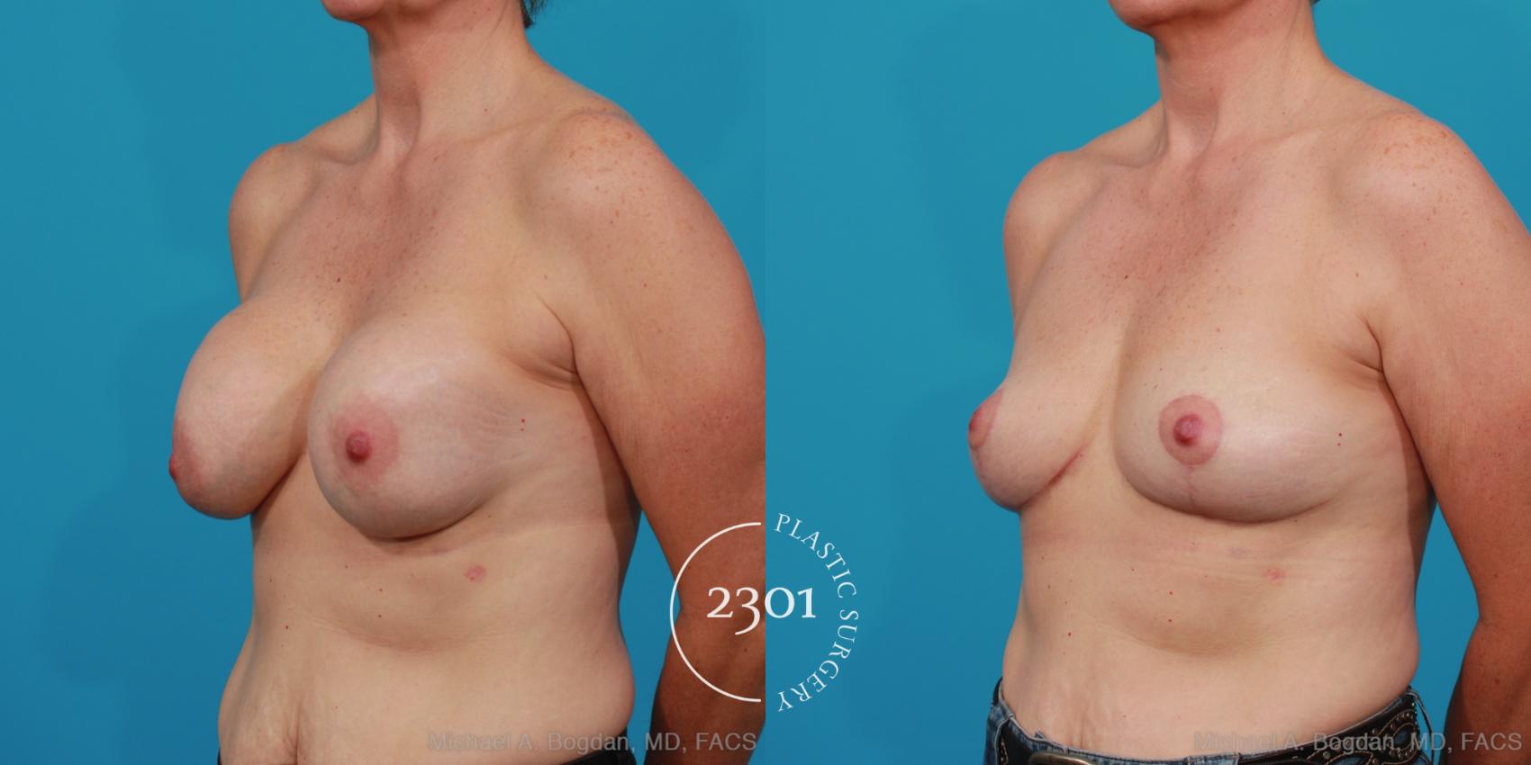 Before & After Breast Augmentation Revision Case 234 View #3 View in Fort Worth, Plano, & Frisco, Texas