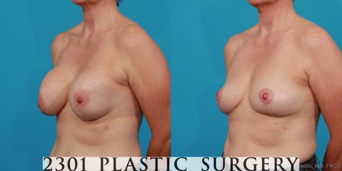 Before & After Breast Augmentation Revision Case 234 View #3 View in Fort Worth, Plano, & Frisco, Texas