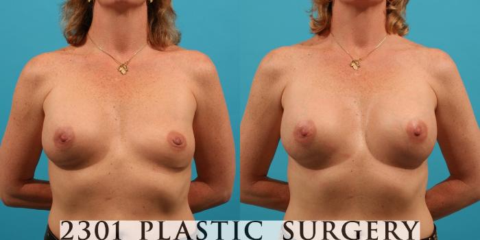 Before & After Saline Implants Case 28 View #1 View in Fort Worth, Plano, & Frisco, Texas
