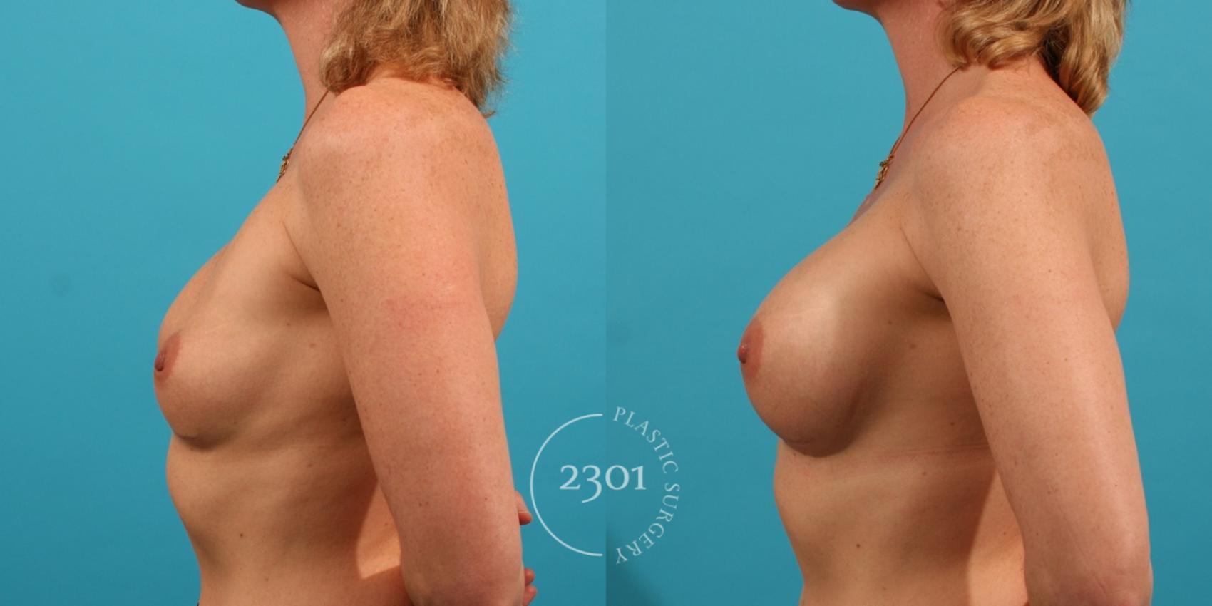 Before & After Breast Augmentation Revision Case 28 View #2 View in Fort Worth, Plano, & Frisco, Texas
