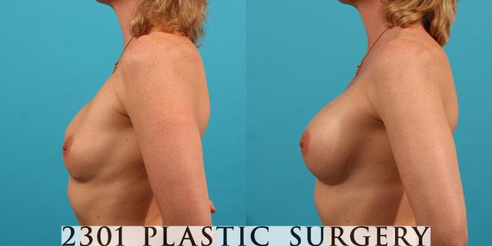Before & After Saline Implants Case 28 View #2 View in Fort Worth, Plano, & Frisco, Texas